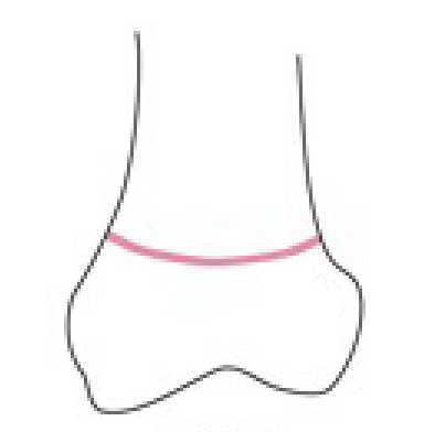 <p>Name this fracture</p>