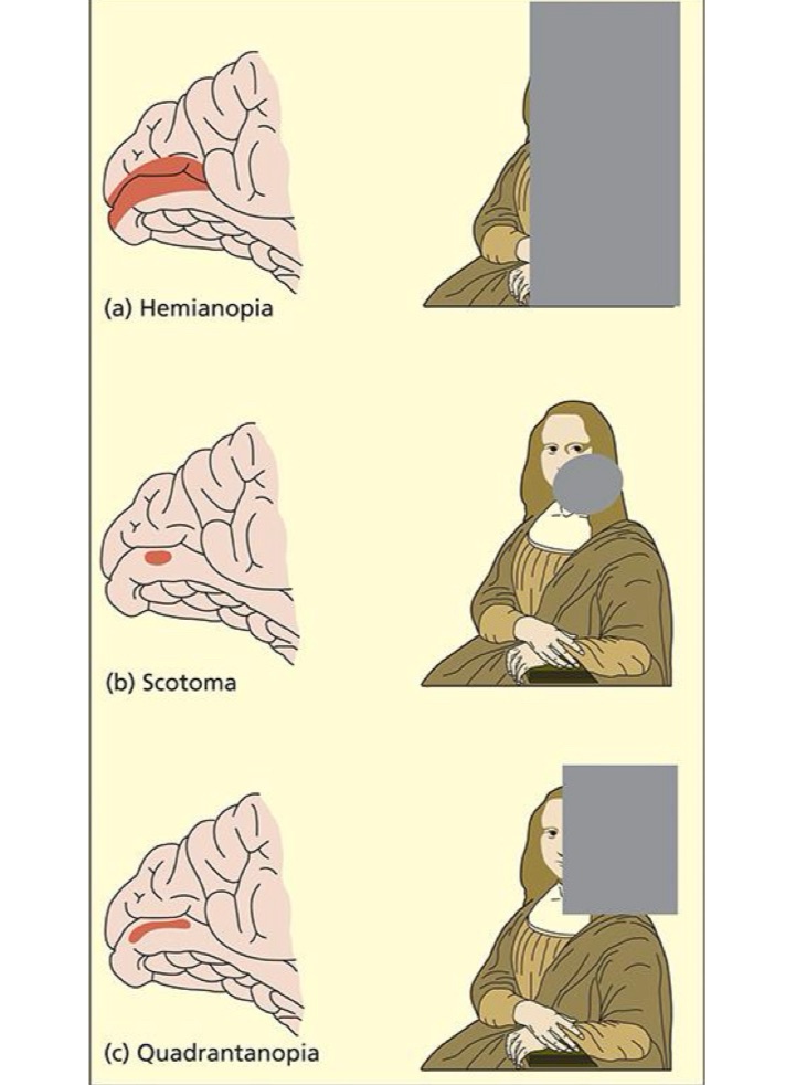 <ul><li><p>Complete damage to one side of V1 = cortical blindness for one side of space (<strong>hemianopia</strong>)</p></li></ul><p>Partial damage can lead to specific areas of blindness:</p><ul><li><p>upper part of V1 = bottom part of space</p></li><li><p>Lower part of V1 = top part of space</p></li></ul><p>→ <strong>quadantanopia</strong></p><p>Small region of damage = <strong>scotoma</strong></p>