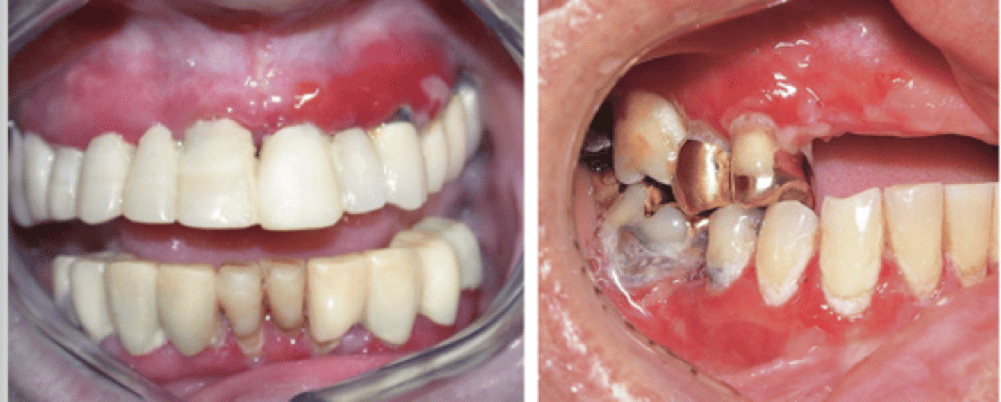 <p>Hint: there is ocular involvement with this patient</p>