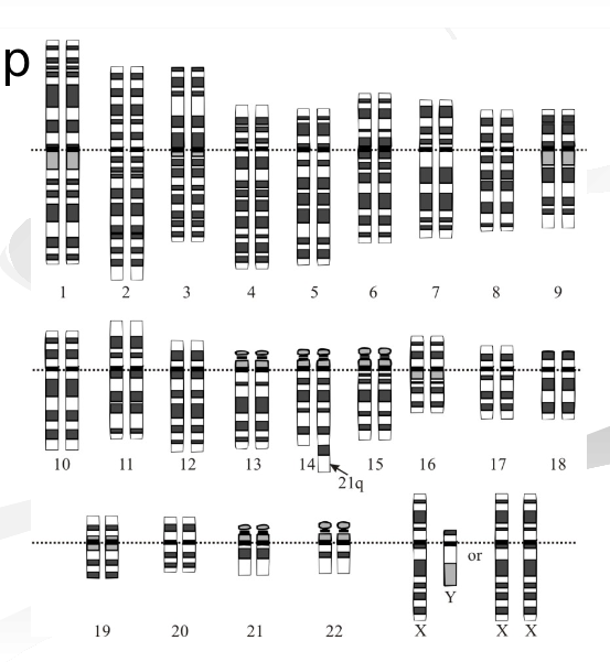<p>what genetic disorder is this</p>