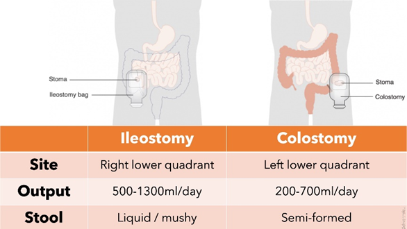 <ol><li><p>ILLEOSTOMY—&gt; right side/ liquid, mushy stool</p></li><li><p>COLOSTOMY—&gt; left side/ semi-formed stool</p><p></p></li></ol><p></p>