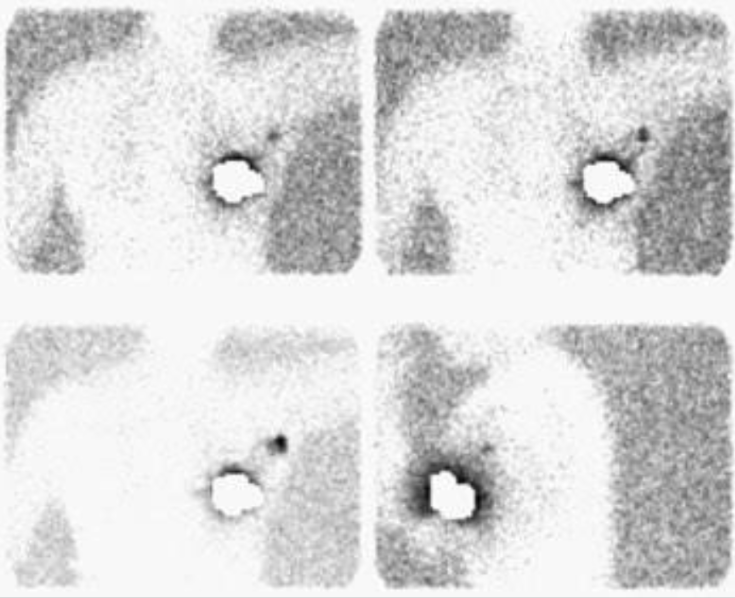 <p>evaluates the patency and anatomy of peripheral lymph vessels by placing a radioactive agent in the tissue drained by the lymph system being evaluated. The test is used to assess lymphedema and tumor involvement or regional lymph nodes that cannot be visualized with other imaging procedures</p>