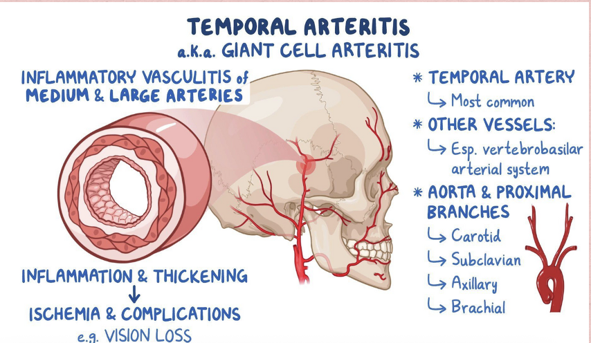 <p><span style="color: yellow"><strong>Background</strong></span>:</p><ul><li><p>Common in elderly (older adults)</p></li><li><p>Inflammation of cranial arteries</p></li><li><p>Localized around temporal arteries</p></li></ul><p><span style="color: yellow"><strong>Clinical Manifestations</strong></span>:</p><ul><li><p>Fatigue, malaise</p></li><li><p>Weight loss</p></li><li><p>Fever</p></li><li><p>Heat, redness, swelling, tenderness or pain over involved artery</p></li><li><p>Vision issues</p></li></ul><p></p>