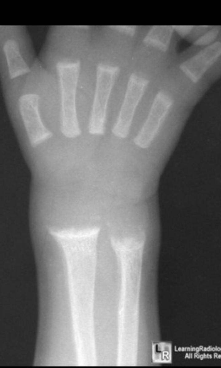 <p>what is this condition and what feature is this image highlighting</p>