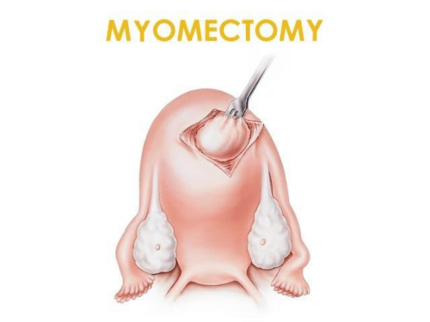 <p>Hormonal contraceptives (combined or progestin-only), with IUDs being most effective for reducing blood loss.</p>