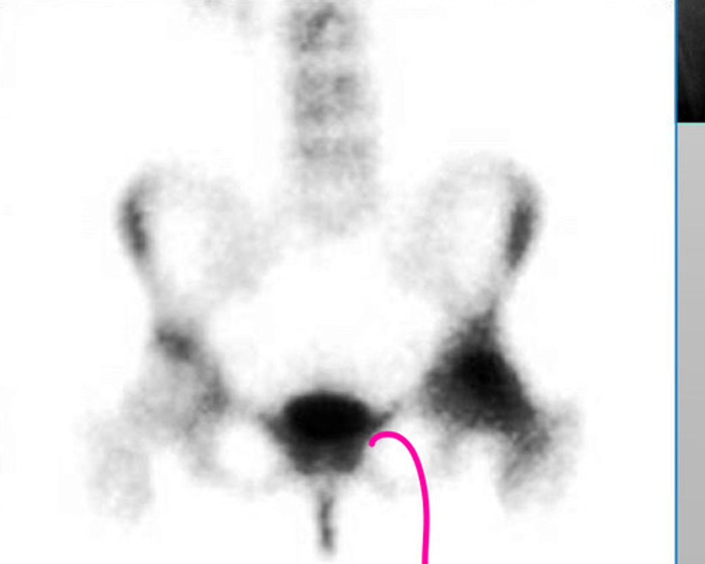 <p>What cause the bladder to glow in a Bone scan?</p>