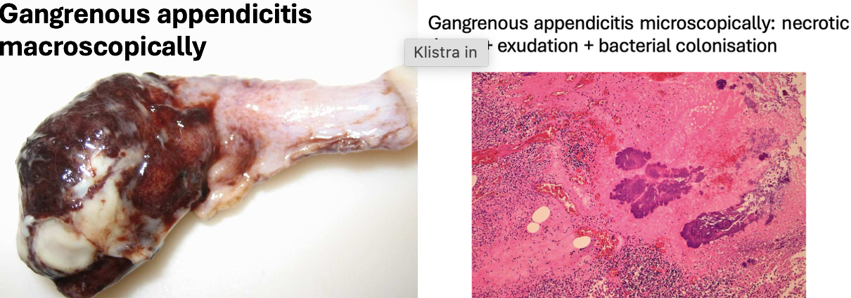 <p><span>Discoloration of appendix</span> and purulent exudate around and inside appendix.</p><p><span>No muscular or submucosal layer is visible → only necrosis</span></p>