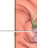 <p>The raised opening in the wall of the duodenum where the hepatopancreatic ampulla typically empties its contents.</p>