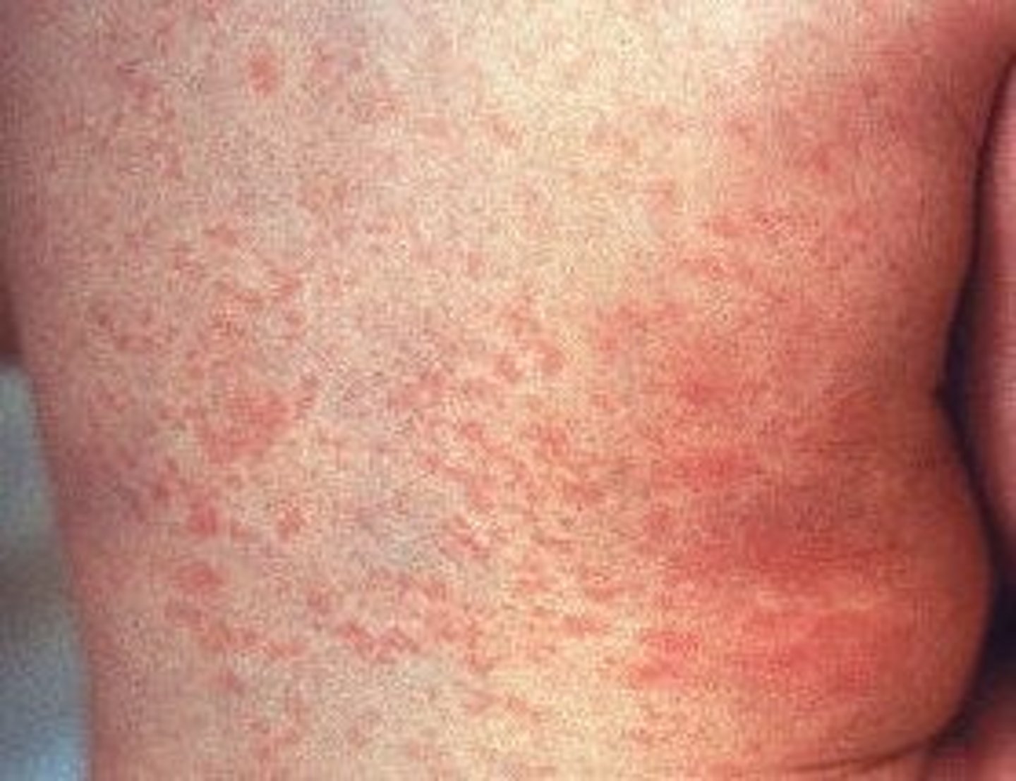 <p>Rubella</p>