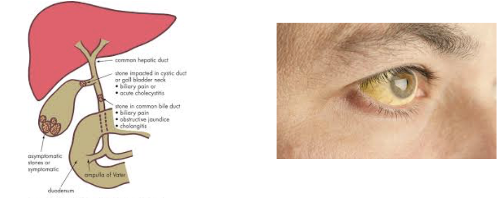 <ul><li><p><strong>EFFECT&nbsp;</strong></p><ul><li><p>Blockage can cause bile salts and pigments to build up in blood → resulting in jaundiced (yellow) skin</p></li></ul></li><li><p><strong>CAUSE</strong></p><ul><li><p>Gallstones&nbsp;</p></li><li><p>Liver failure&nbsp;</p></li></ul></li></ul><p></p>