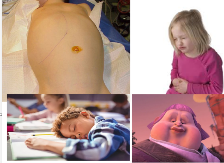 <ol><li><p>Abdominal Mass</p></li><li><p>Pain</p></li><li><p>Malaise (lethargy) </p></li><li><p>Horner’s Syndrome </p></li></ol><p></p>