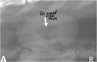 <p>peripelvic fat</p>