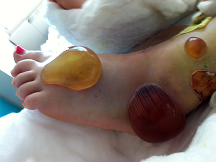 <p>Skin overlying fractured bone</p><ul><li><p>places with less scar tissue (tattoos hurt the most)</p></li><li><p>Tx: soft dressings, surgery</p></li><li><p>DO NOT POP</p></li></ul><p></p>
