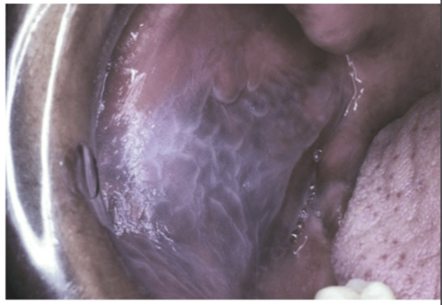 <p>What is Leukodema considered? Who is it more common and severe in? What type of condition is it? </p>