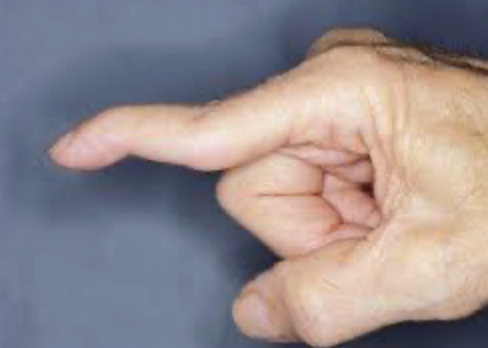 <p>flexion of the MCP and DIP joints and hyperextension of the PIP joint </p>