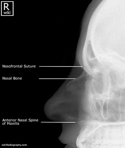 <p>Nasal bone fracture.</p>