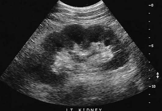 <p>which congenital anomaly is identified in this kidney</p>