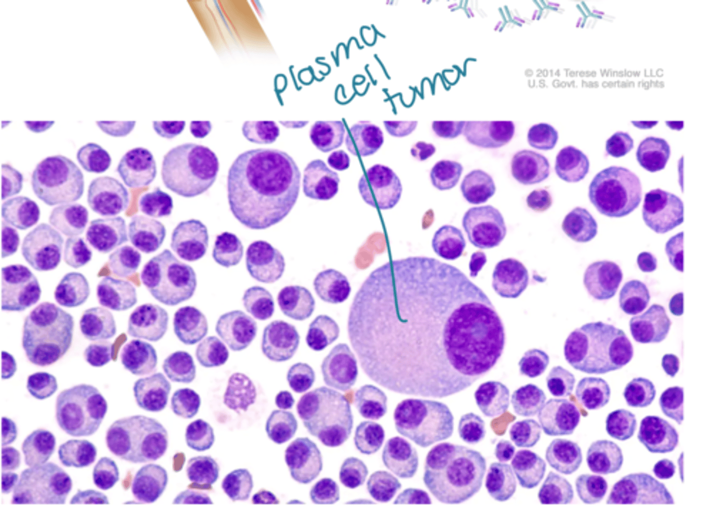 <p>- Hematopoietic neoplasia (plasma cells) producing antibodies</p><p>- Composed of immunoglobulin light chains secreted in blood, precipitate in capillary basement membranes</p>