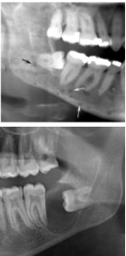 <p>In order to know where the lesion is, what do you have to do?</p>