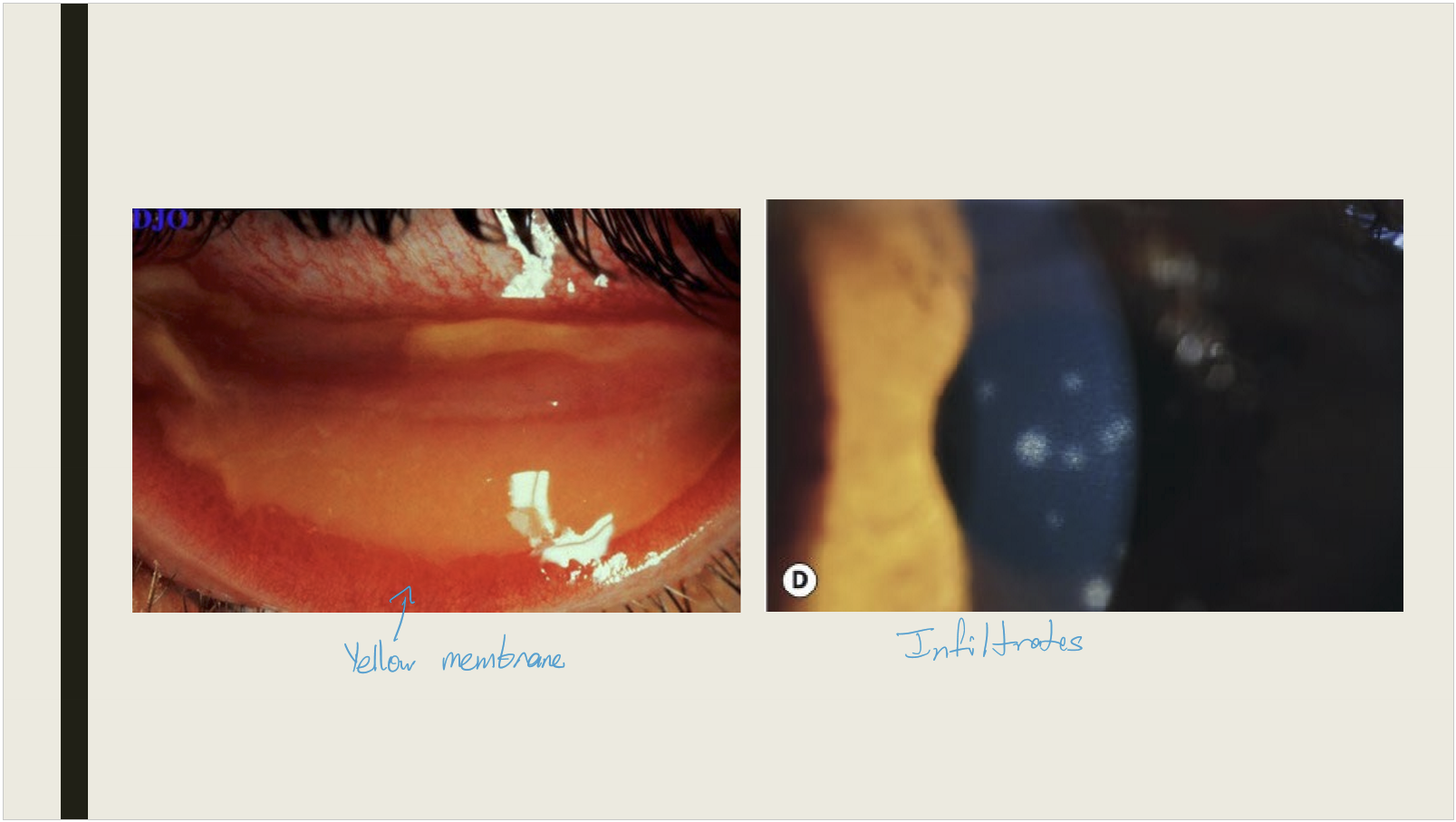 <ul><li><p>Discharge-clear or yellow</p></li><li><p>Eyelid swelling</p></li><li><p>Bulbar and palpebral conj hyperemia</p></li><li><p>Conj chemosis (swelling) with follicular reaction&nbsp;</p></li><li><p>Keratitis: epithelial microcysts are in early stage; punctate epithelial erosions seen day 7-10; inflitrates develop day 14 and may last from months to years&nbsp;</p></li><li><p>Membrane or pseudomembrane formations: can cause irritation</p></li><li><p>preauricular lymphadenopath&nbsp;</p></li></ul><p></p>
