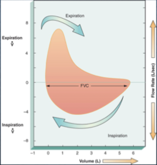 <p>•delayed and prolonged expiratory flow, often described as "t" or "dipping," with a <mark data-color="red" style="background-color: red; color: inherit;">low peak expiratory flow and a prolonged expiratory phase</mark> that doesn't reach zero</p><p></p><p>condition that narrows the airways, such as:</p><ul><li><p>Asthma&nbsp;</p></li><li><p>COPD (chronic bronchitis, emphysema)&nbsp;</p></li><li><p>Large airway tumors&nbsp;</p></li></ul><p></p>