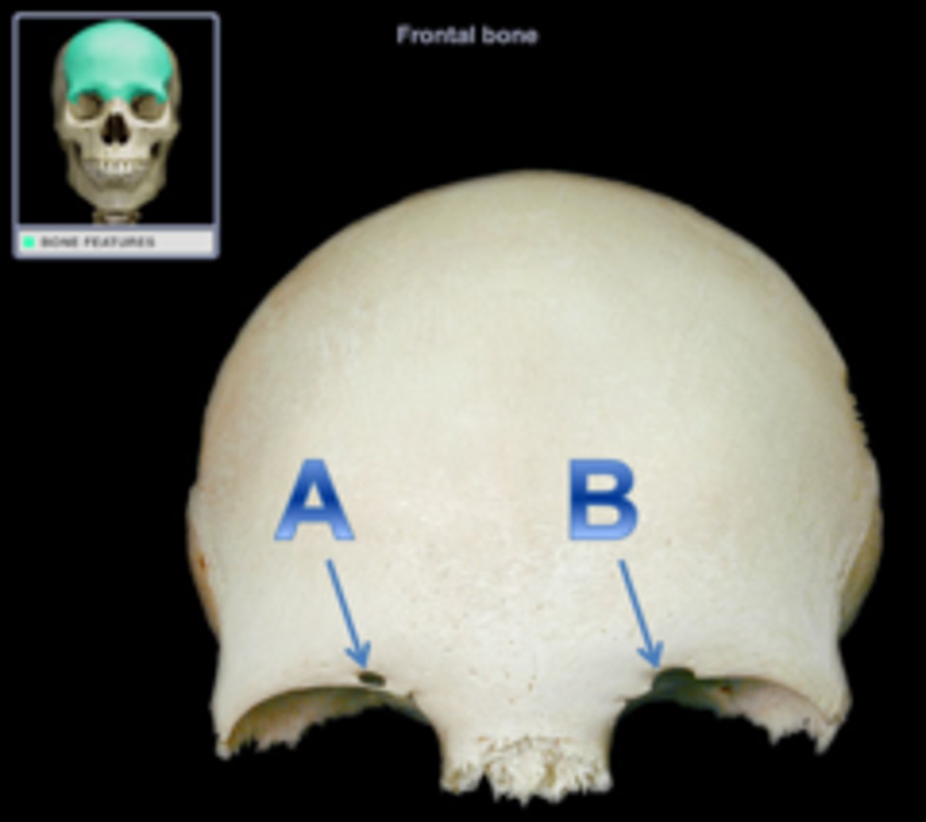 <p>an incomplete supra-orbital foramen</p>