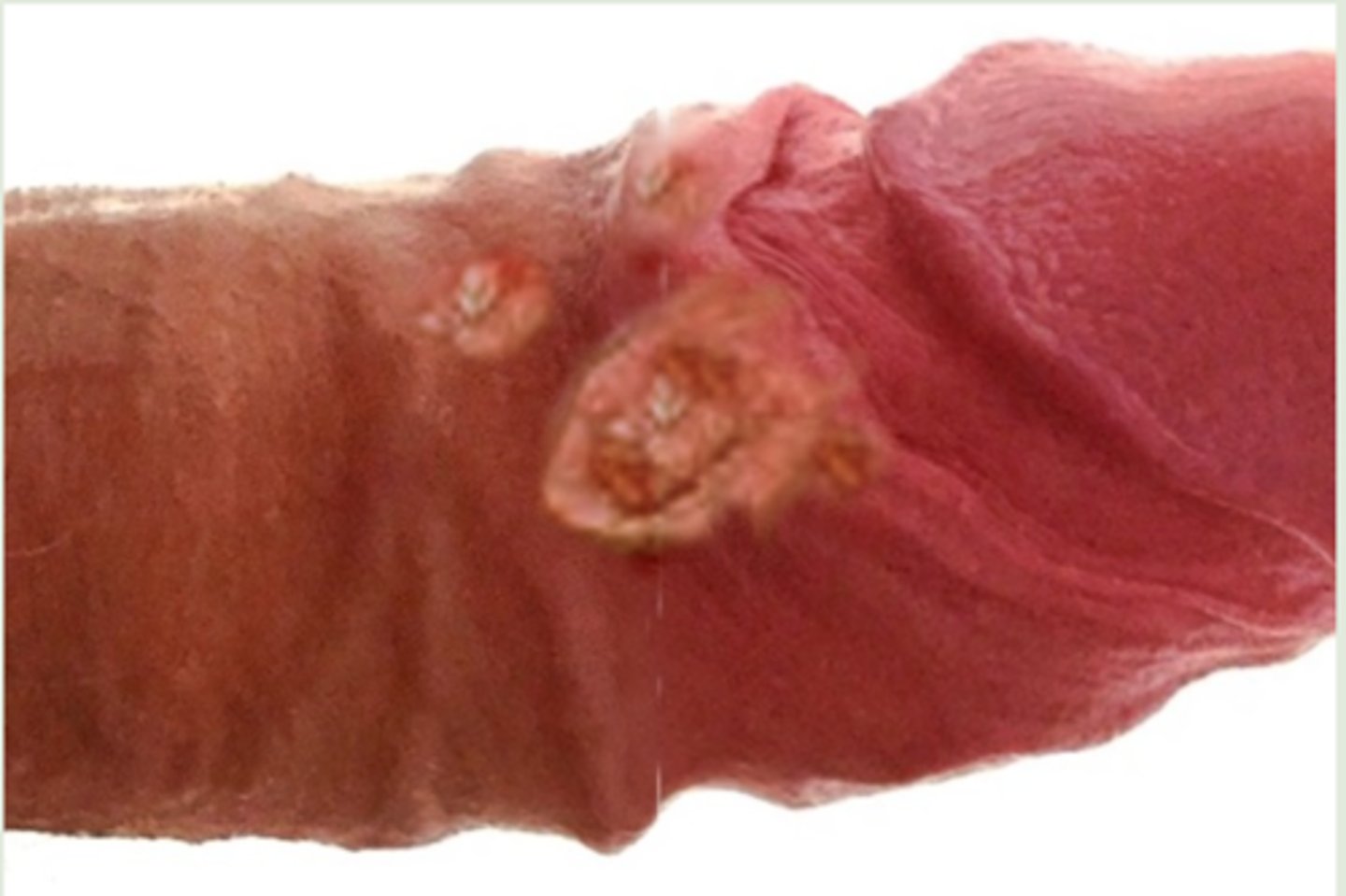 <p>lymphogranuloma venereum</p>