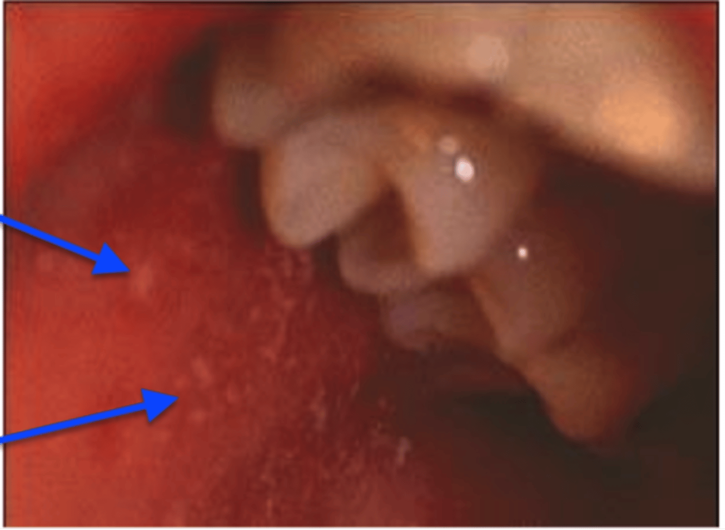 <p>are erythematous macules with white necrotic centers that may occur in the oral cavity in patients with measles</p>