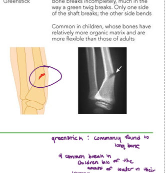 <p>bone breaks incompletely.</p><p>one side of the shaft breaks, while the other side bends   </p><ul><li><p>commonly occurs in children because of the amount of water in their bones. </p></li></ul>