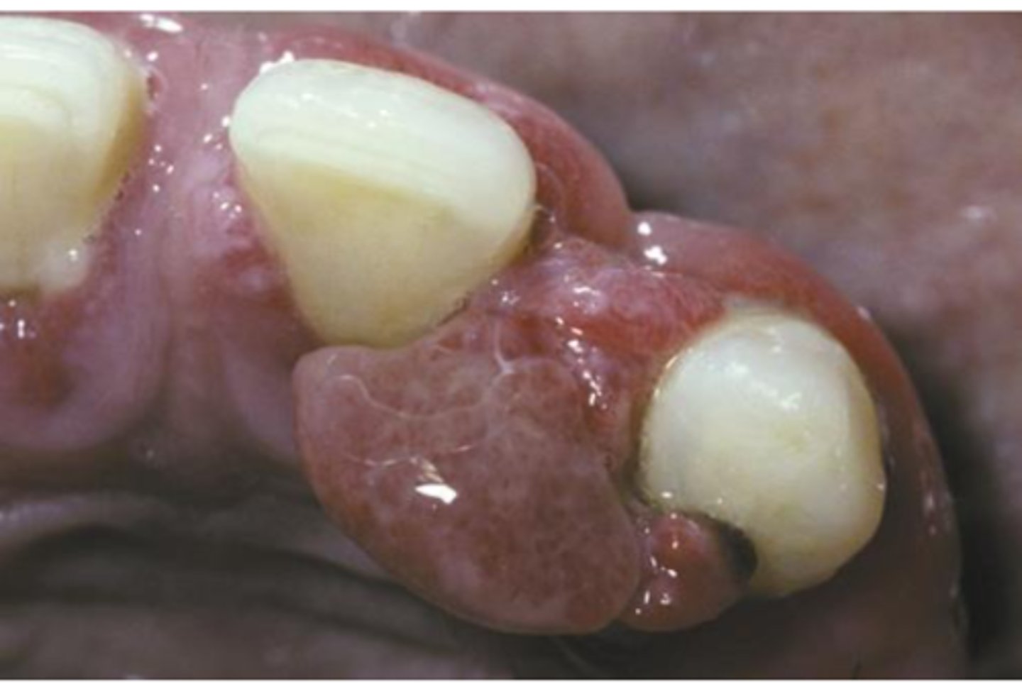 <p>• Common</p><p>• Cause: local irritation or trauma</p>