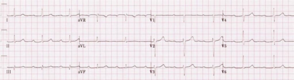 <p>what rhythm is shown in the ECG</p>