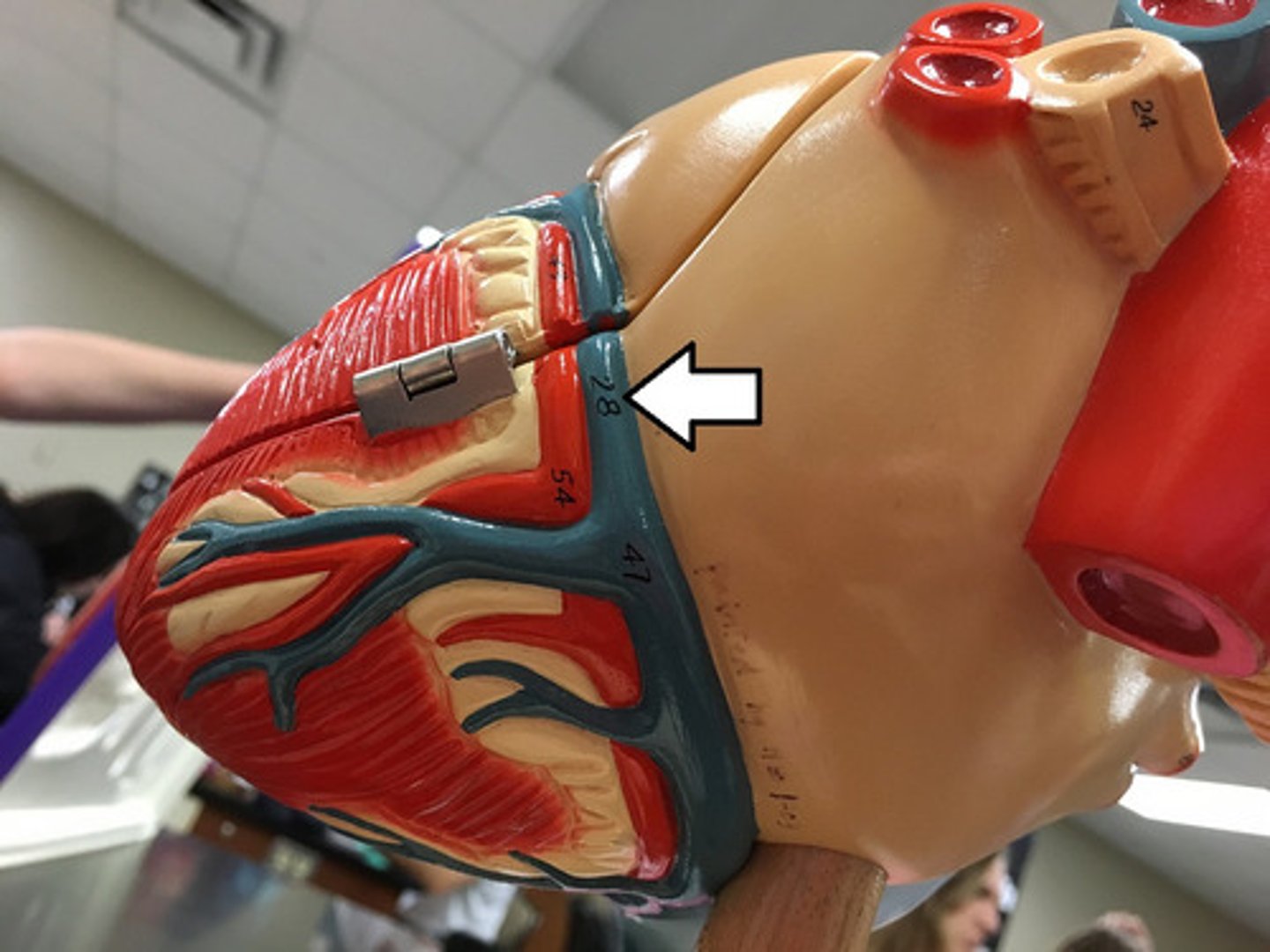 <p>goes left of coronary sinus</p><p>ST</p><p>will be lifted</p>