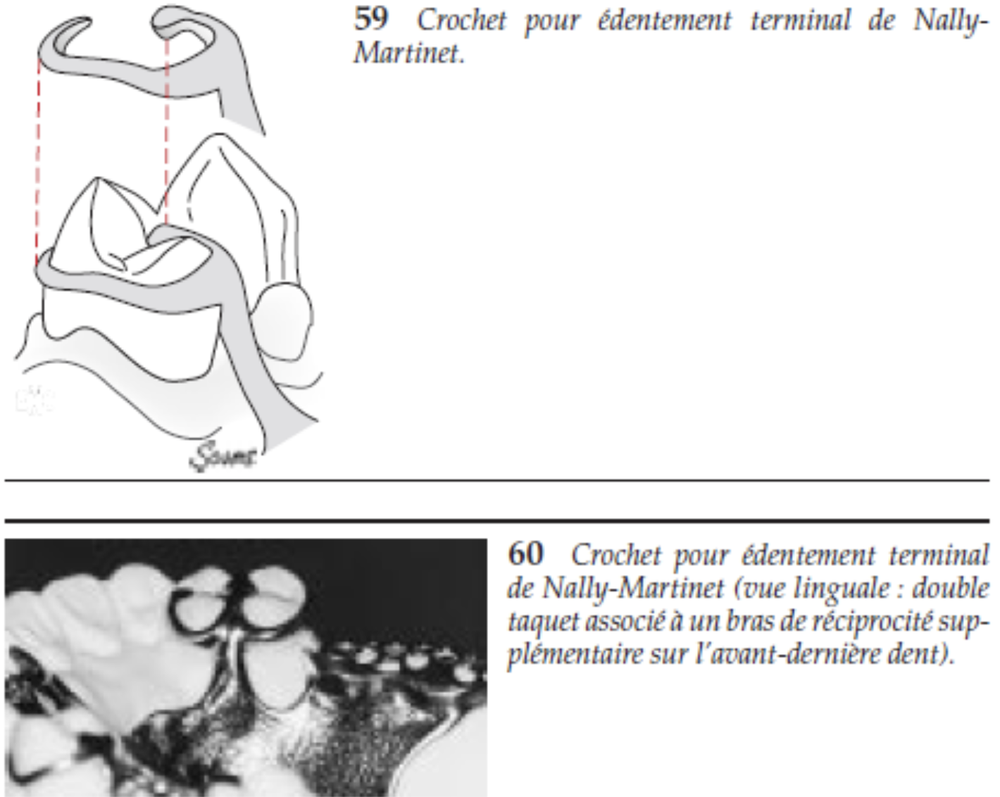 <p>Prothèse Amovible Partielle : Les différents types de crochets : <strong>crochet de Nally-Martinet </strong></p>