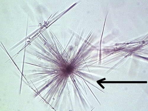 <ol><li><p>Identify pointed structure.</p></li><li><p>In what disorder is this structure seen?</p></li></ol><p></p>