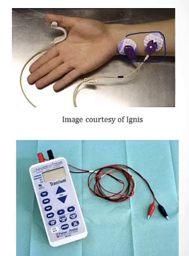 <p>-neuromuscular blockade; under anesthesia</p><p>-electrical stimulations; nerve; 1; 2</p>