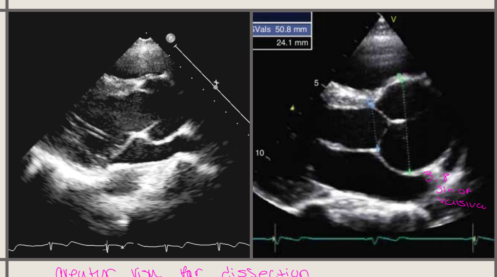 <p>Aortic root dilatation is the most specific MFS</p><p>finding</p><p>“Onion shape” AORTIC ROOT</p><p>The aortic sinus, the sinotubular junction, aortic</p><p>annulus, and ascending aorta should be measured</p>