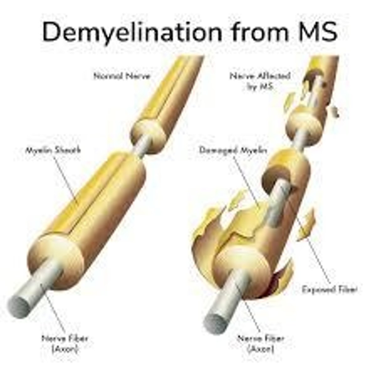 <p>A condition characterized by the loss of myelin sheath leading to weak muscles and paralysis.</p>