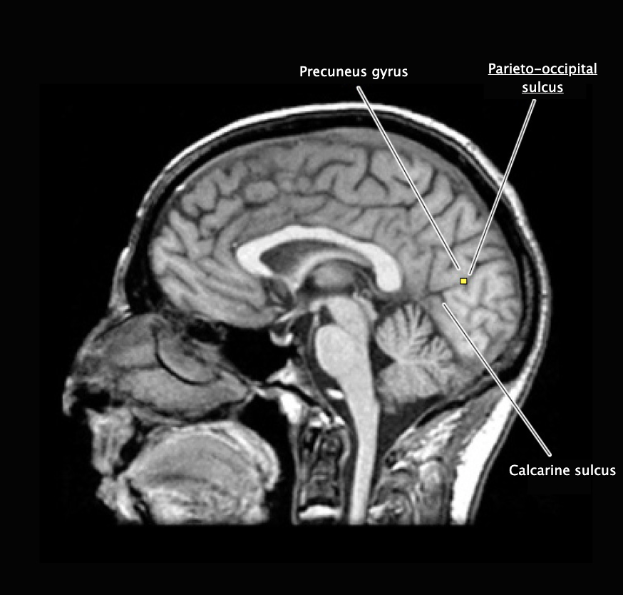 <p>Prominent vertically oriented sulcus on the medial aspect of the hemisphere that divides the parietal and occipital lobes; intersects the anterior terminus of the calcarine sulcus at nearly a right angle.</p>