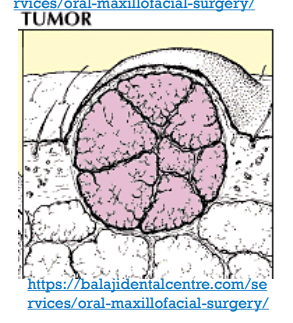 <p>TUMOR:</p>