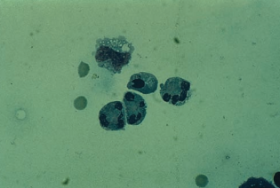 Figure 7: Neutrophils with pyknotic nuclei