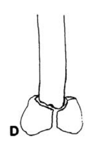 <p>Indirect fractures Vertical compression </p>