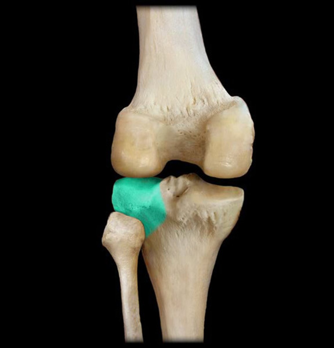 <p>The lateral side of the tibial plateau ( the side were the fibula is located.</p>