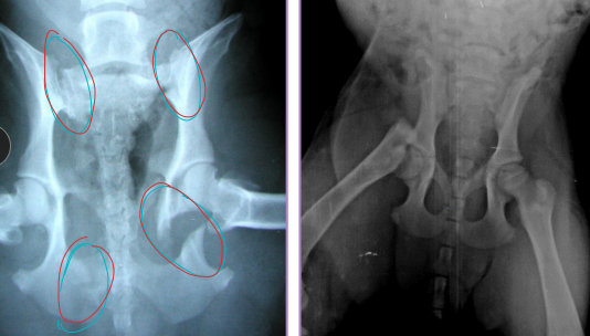 <ul><li><p><span style="background-color: transparent;"><strong><span>Capital Physis: </span></strong><u><span>Salter-Harris I</span></u><span>, skeletally immature</span></span></p><ul><li><p><span style="background-color: transparent;"><strong><span>Dt:</span></strong><span> AP & frog-leg radiographs</span></span></p></li><li><p><span style="background-color: transparent;"><strong><span>Tx:</span></strong><span> K-wires (diverging/parallel), temp“apple-coring” due to pins and blood supply</span></span></p></li></ul></li><li><p><span style="background-color: transparent;"><strong><span>Patellar fractures: uncommon, direct blow</span></strong></span></p><ul><li><p><span style="background-color: transparent;"><strong><span>Apical (<1/3 patella):</span></strong><span> excision</span></span></p></li><li><p><span style="background-color: transparent;"><strong><span>Multifragmentary</span></strong><span>: patellectomy</span></span></p></li><li><p><span style="background-color: transparent;"><strong><span>Transverse (#1):</span></strong><span> wire + tension band</span></span></p></li></ul></li><li><p><span style="background-color: transparent;"><strong><span>Greater Trochanter Avulsion:</span></strong><span> Young, gluteal muscle traction</span></span></p><ul><li><p><span style="background-color: transparent;"><strong><span>Tx:</span></strong><span> pin + tension band</span></span></p></li></ul></li><li><p><span style="background-color: transparent;"><strong><span>Diaphyseal fractures (#1)</span></strong></span></p><ul><li><p><span style="background-color: transparent;"><strong><span>Tx:</span></strong><span> plate + screws, interlocking nail, IM pin + cerclage</span></span></p><ul><li><p><span style="background-color: transparent;"><span>ESF not recommended as no safe corridors</span></span></p></li><li><p><span style="background-color: transparent;"><strong><u><span>Compartment syndrome: muscles feel like rock</span></u></strong></span></p></li></ul></li></ul></li><li><p><span style="background-color: transparent;"><strong><span>Distal Physeal fractures:</span></strong><span> young, </span><u><span>Salter-Harris type</span></u><span>, growth plate involvement</span></span></p><ul><li><p><span style="background-color: transparent;"><strong><span>Tx: </span></strong><span>cross pins (linear), plates (if comminuted)</span></span></p><ul><li><p><span style="background-color: transparent;"><u><span>Risk of quadriceps contracture(esp. extended postion) peg leg</span></u></span></p></li></ul></li></ul></li></ul><img src="https://knowt-user-attachments.s3.amazonaws.com/780203db-9ec6-4c5a-bdad-d40013945602.png" data-width="25%" data-align="center"><p></p>