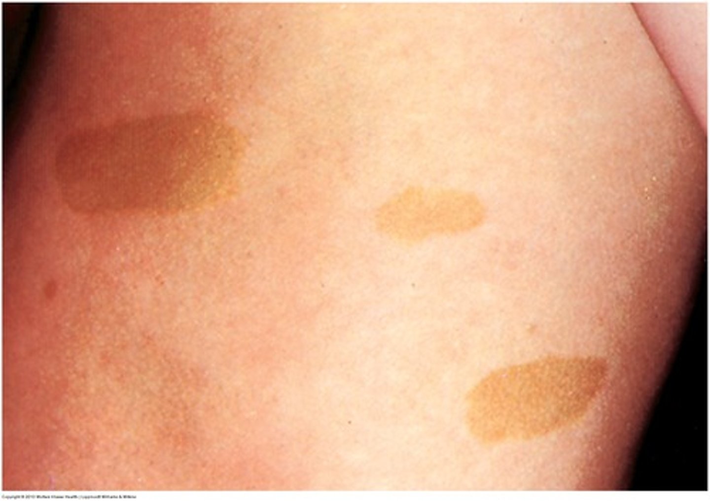 <p>Slightly but uniformly pigmented macule or patch with a somewhat irregular border<br><br>Benign: 0.5-1.5 cm<br>Neurofibromatosis: six or more spots measuring &gt;1.5 cm</p>