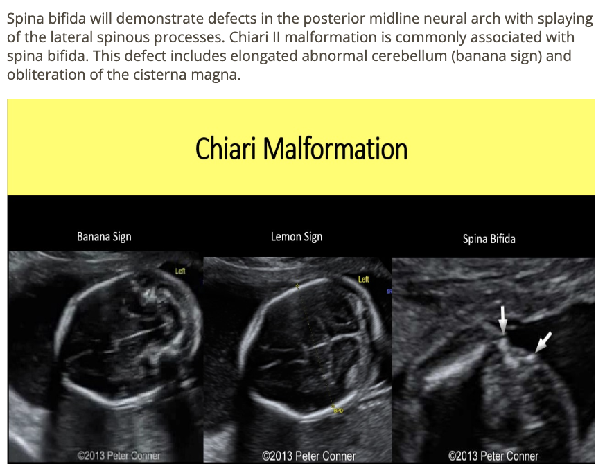 <p>b) spina bifida </p>