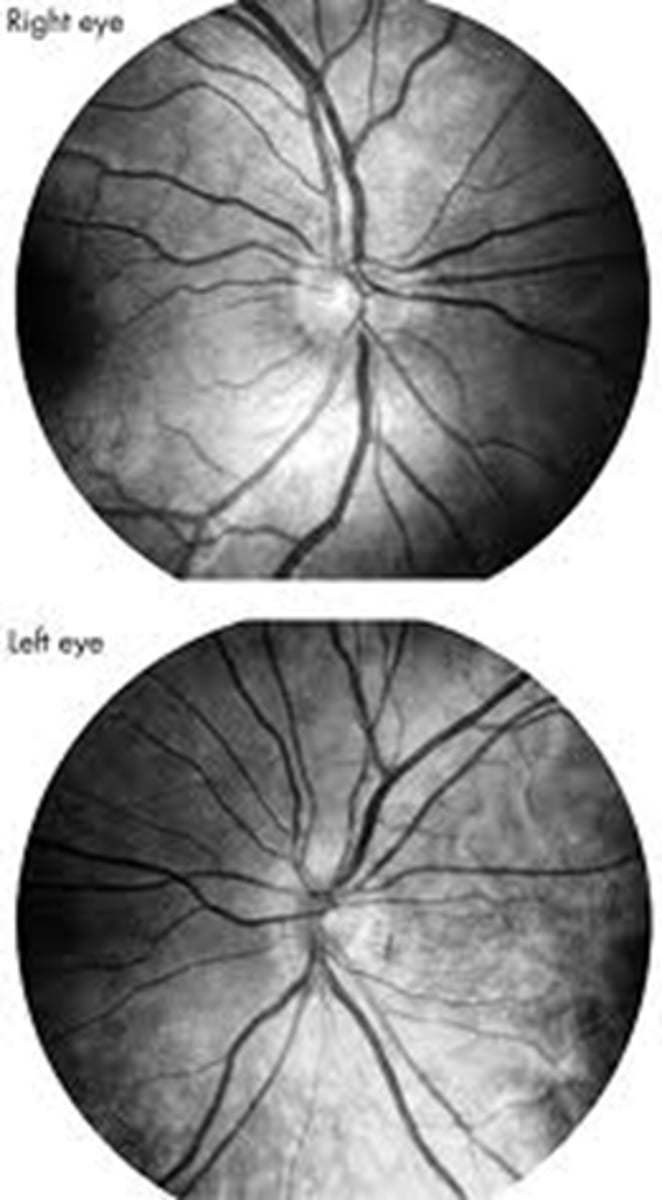 <p>no management necessary other than routine following with an OD/OMD and pediatrician to monitor for endocrine/neuro issues</p>