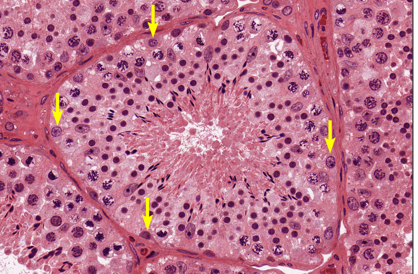 <p>histo; larger nucleus but pretty solidified</p>