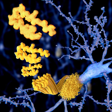 <p>Alzheimer’s patients experience inflammation that causes the beta-amyloid to accumulate and join with clumps of dead neurons and glial cells, forming large masses called </p>