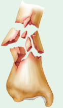 comminuted fracture 