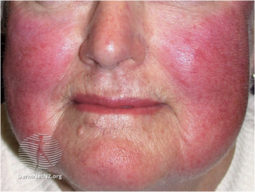 <p>Rosacea </p>